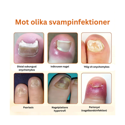 Propofix™ | Hjälper till att minska nagelsvamp och förbättra naglarnas utseende på upp till 7 dagar.