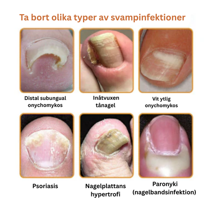 Propofix™ | Hjälper till att minska nagelsvamp och förbättra naglarnas utseende på upp till 7 dagar.