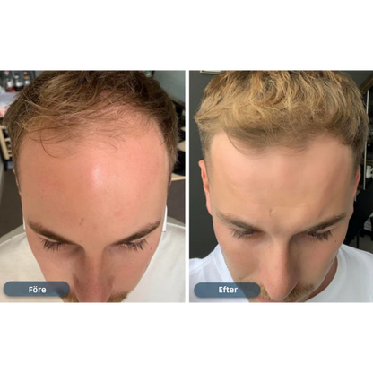 HårVäxt™ – Minoxidil lotion 5 % (1 månads förråd)