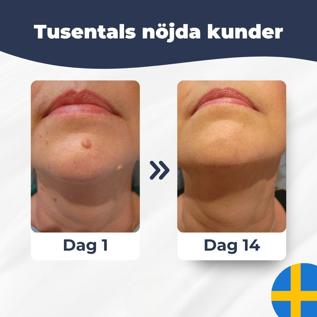 HudFix™ – Hudfliksborttagare