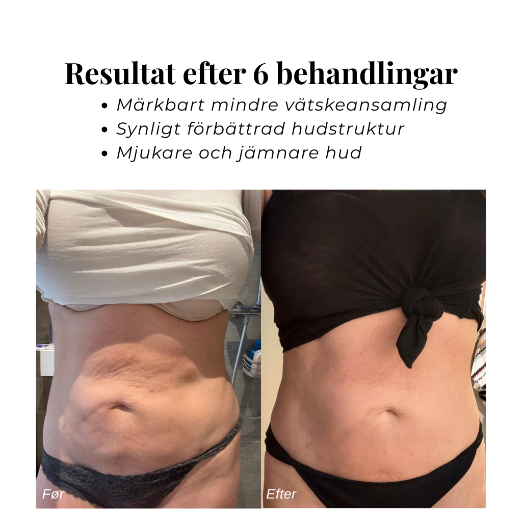 CircuDerm™ – Anti-cellulit massageapparat