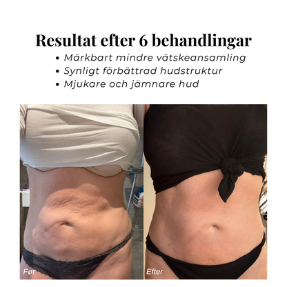 CircuDerm™ – Anti-cellulit massageapparat